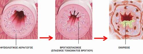 βρογχικό άσθμα